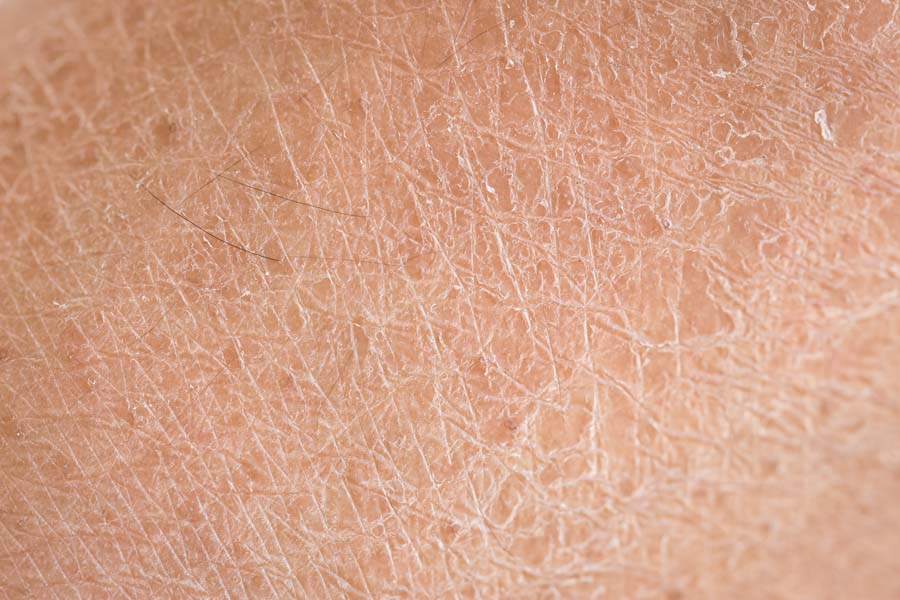 closeup of dry skin (ichthyosis) detail